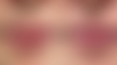 Fordyce'i graanulid huultel: fotod enne ja pärast ravi