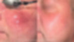 Before and after images of a facial treatment showing reduced redness on a cheek. Text: Dr. Alexander Uskov MD PhD.