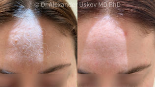 Ennen ja jälkeen -valokuva talirauhasten hyperplasian poistosta otsan alueella.