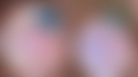 Lähivõte näost, mis on jagatud kaheks osaks, näidates nahka enne ja pärast protseduuri. Silmi katavad kaitseprillid. Tekst: © Dr Alexander Uskov MD PhD.