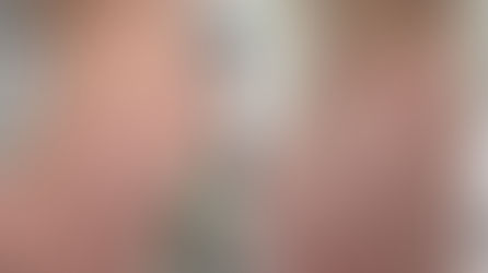Ennen–jälkeen-kuva, jossa näkyy naisen lonkka venytysarpien kanssa. Jälkikuvassa venytysarvet ovat lääketieteellisen laserhoidon jälkeen lähes huomaamattomat.