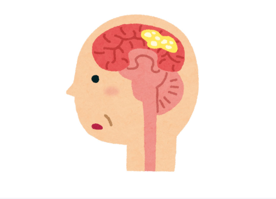 dieta w chorobie Alzheimera