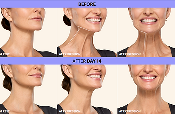 Botox Examples - Neck
