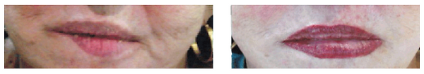 Before and After Lip
