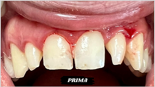 faccette dentali