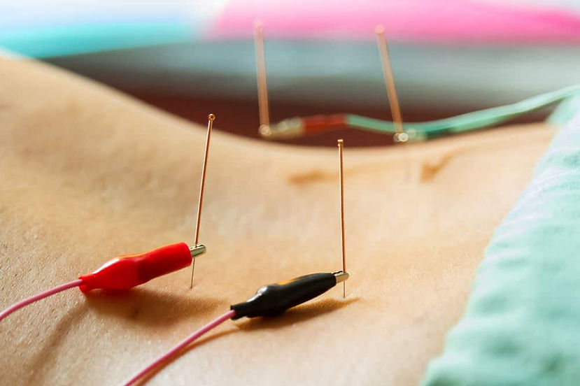 electrical-stimulation-acupuncture.jpg