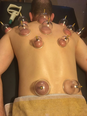 Cupping therapy
