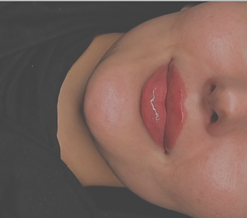 derby-lip-filler.png