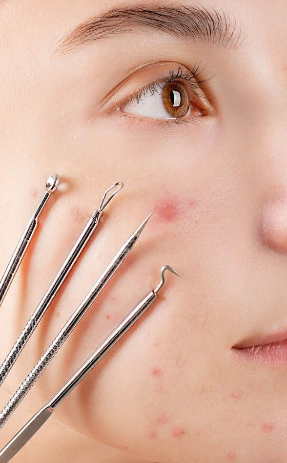 Acne vulgaris