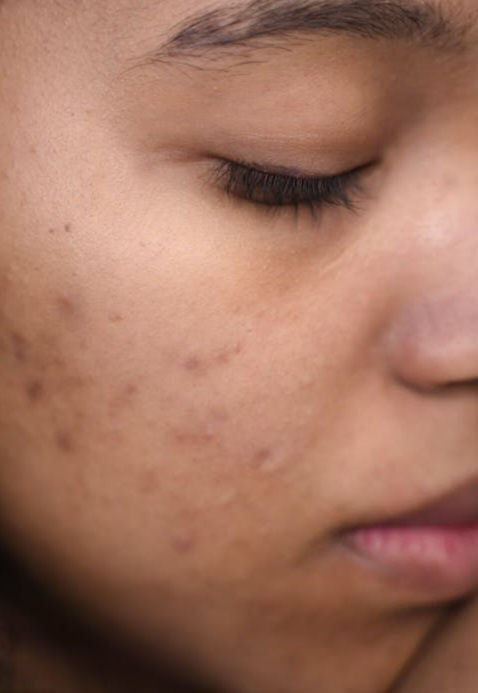 Hyperpigmentation and chemical peeling