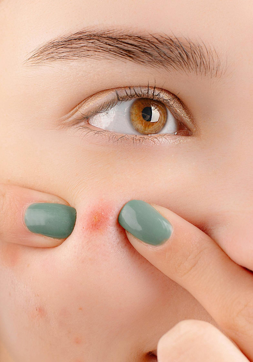 squeezing and picking at pimples