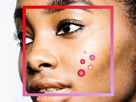 Before the Breakout: How to Identify and Treat Pre-Acne Skin - Part I