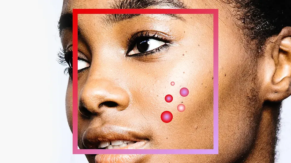 Before the Breakout: How to Identify and Treat Pre-Acne Skin - Part I