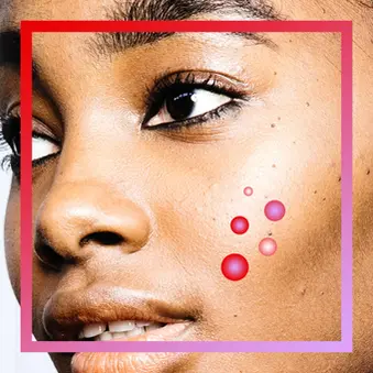 Before the Breakout: How to Identify and Treat Pre-Acne Skin - Part I