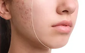 Before the Breakout: How to Identify and Treat Pre-Acne Skin - Part II