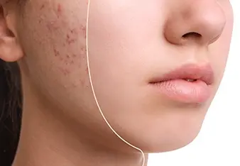 Before the Breakout: How to Identify and Treat Pre-Acne Skin - Part II