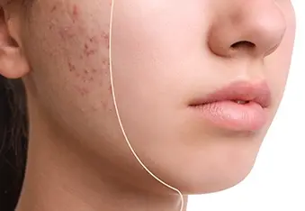 Before the Breakout: How to Identify and Treat Pre-Acne Skin - Part II