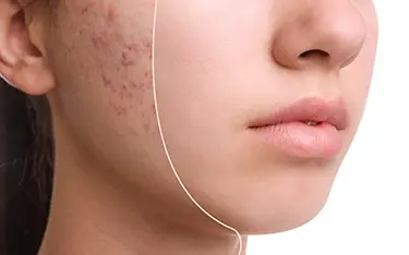 Building skin resilience while managing acne means dealing with inflammation and strengthening the skin barrier.
