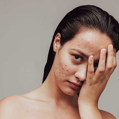 7 Reasons Why Your Acne Isn't Going Away