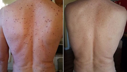 als-back-before-and-after-700-compressed