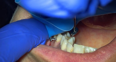 Dr. Michael Wenzel placing a rubber dam clamp through the dental operating microscope.