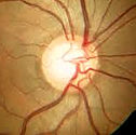 Glaucoma en León