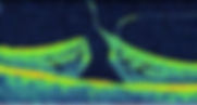 Agujero Macular en León
