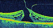 Agujero Macular en León