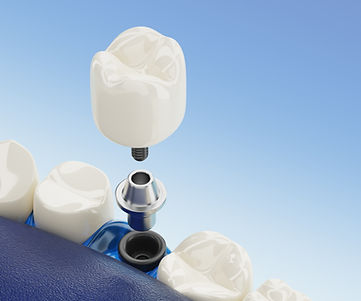 close-up-component-dental-implants-transparent-3d-rendering.jpg