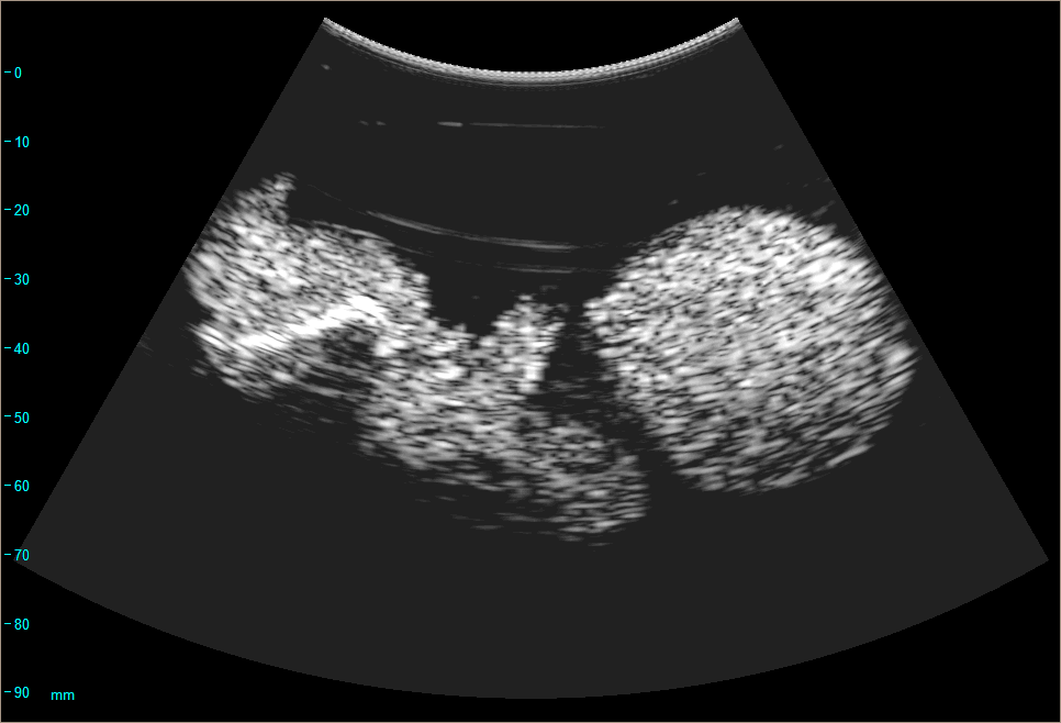 Miniature : Modèle de "foetus" pour ultrasons