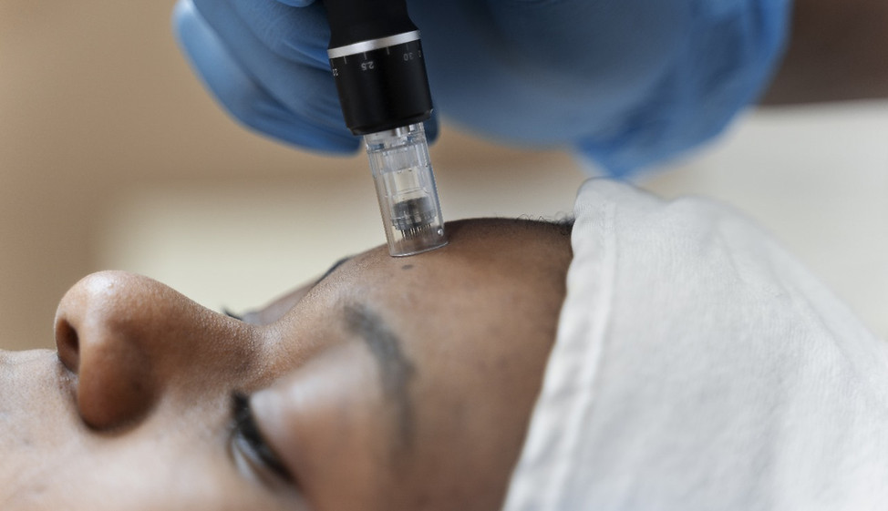 Microneedling treatment by Sonia.jpg