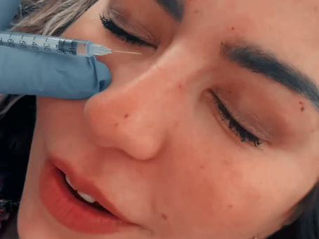 Dermal Fillers in North York: Lip, Cheek, Chin, and Jawline Filler at Sonia Cosmetic