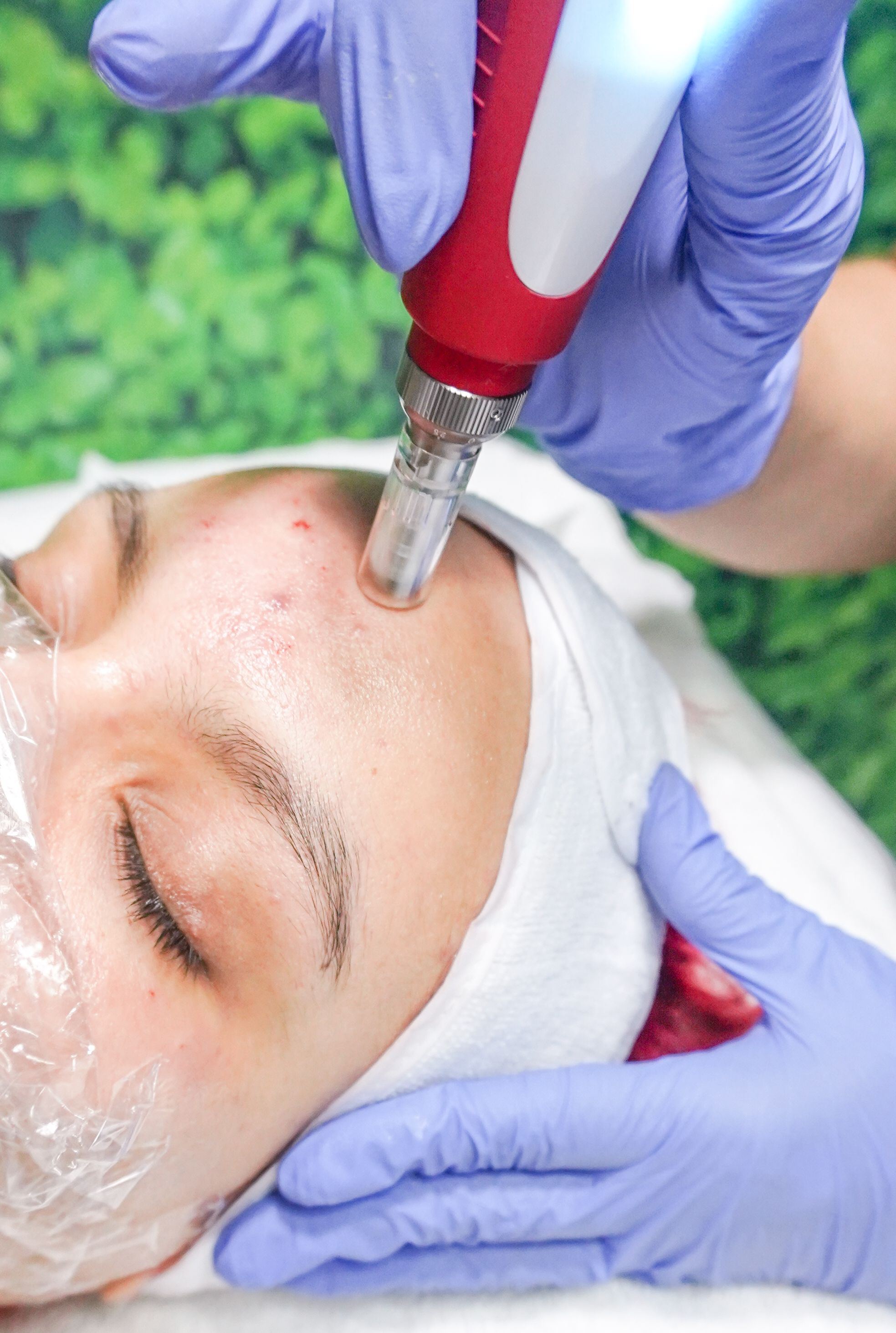 PDRN salmon DNA microneedling facial treatment in North York at Sonia Cosmetic Clinic