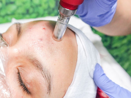 PDRN Microneedling: The Complete Guide to the 'Salmon DNA Facial'