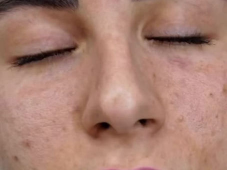 PDRN Microneedling (Salmon DNA) in Toronto: What It Is and Why It Is Different