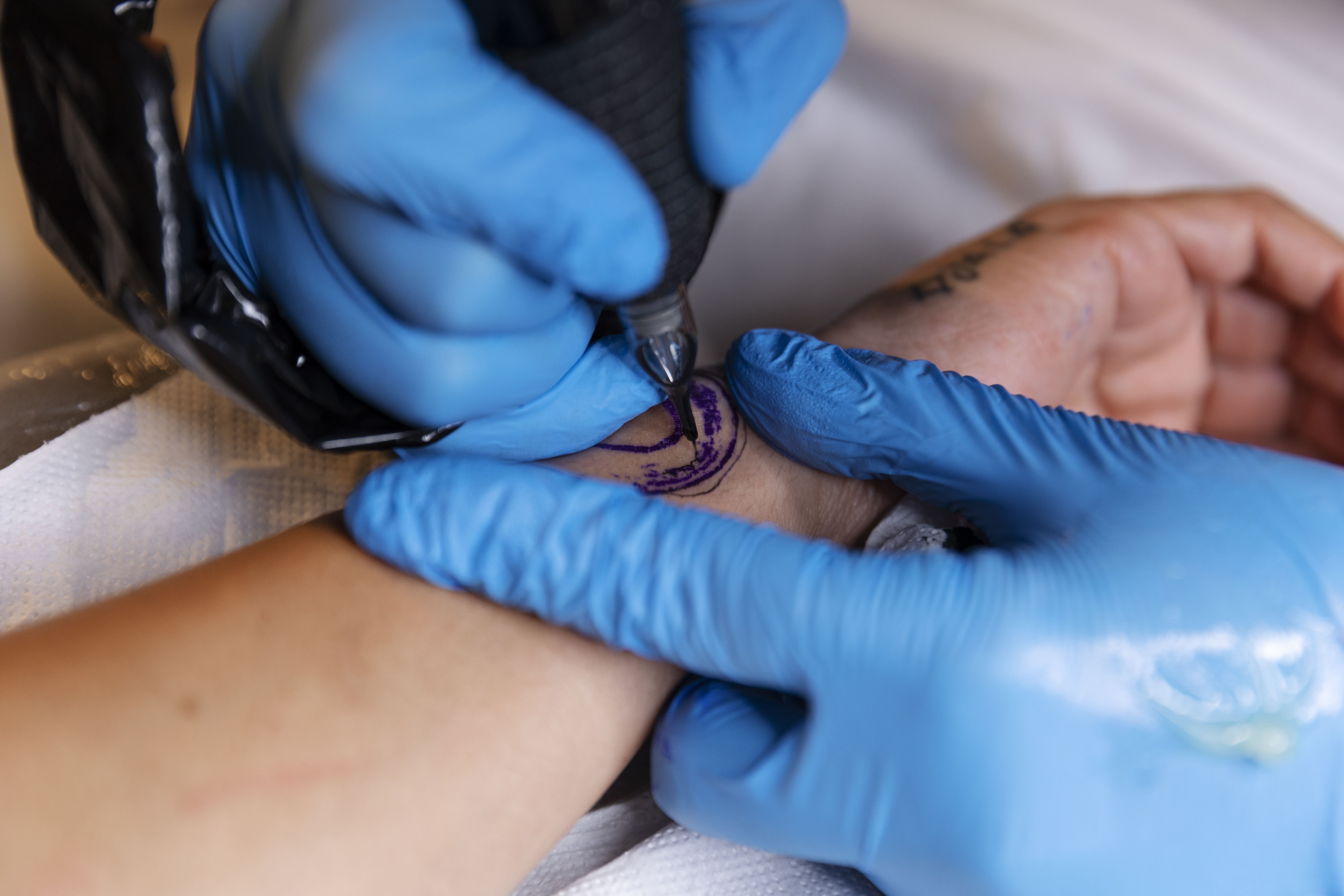 Laser tattoo removal in North York Toronto at Sonia Cosmetic Clinic