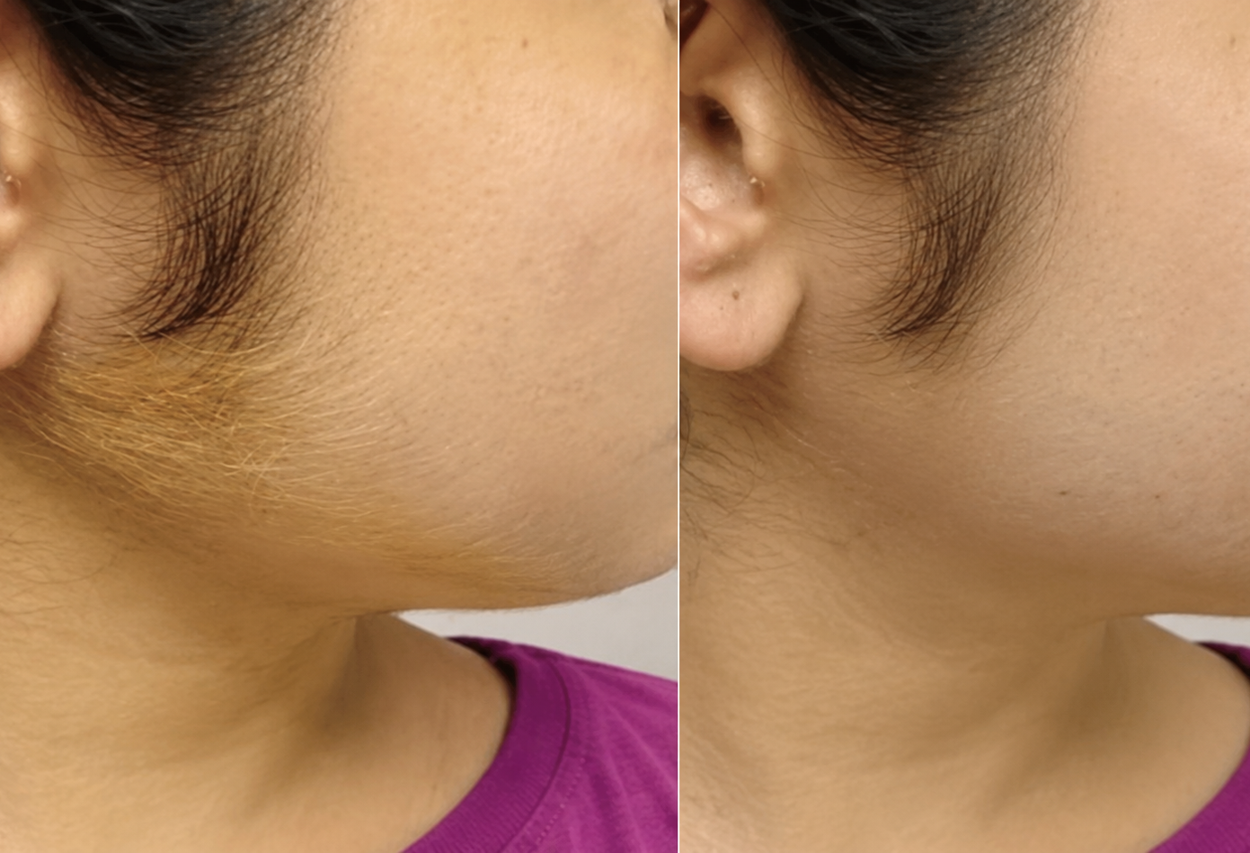 Laser facial hair bleaching North York - Sonia Cosmetic Clinic
