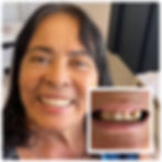 Clareamento, Gengivoplastia, PRótese Fixa e Prótese Parcial Removível
