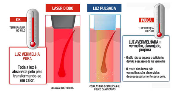 depilação a laser - depilação definitiva - laser de diodo - milesman - maringa - curitiba - clinica de estetica