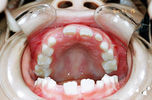 687_伊藤 なごみ_20041112_画像 口腔内写真_上顎.jpg