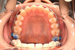 687_伊藤 なごみ_20140222_画像 口腔内写真_上顎.jpg