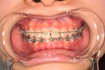 687_伊藤 なごみ_20140222_画像 口腔内写真_正面.jpg