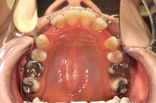 11115_後藤 章子_20120327_画像 口腔内写真_上顎.jpg