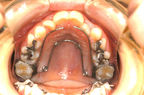903_平田 琳子_20080609_画像 口腔内写真_上顎.jpg