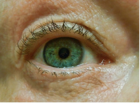 Increasing the Accuracy of Early Parkinson’s Disease Diagnosis with Slow Saccadic Intrusions