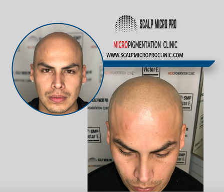 Scalp Micropigmentation | Scalp Micro Pro Clinic | United ...