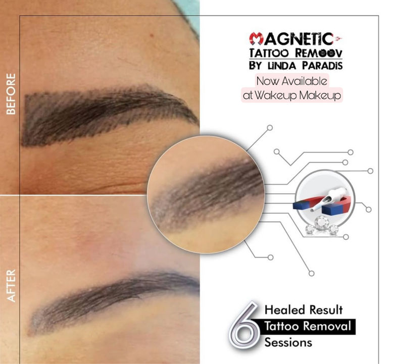 Brow Removal