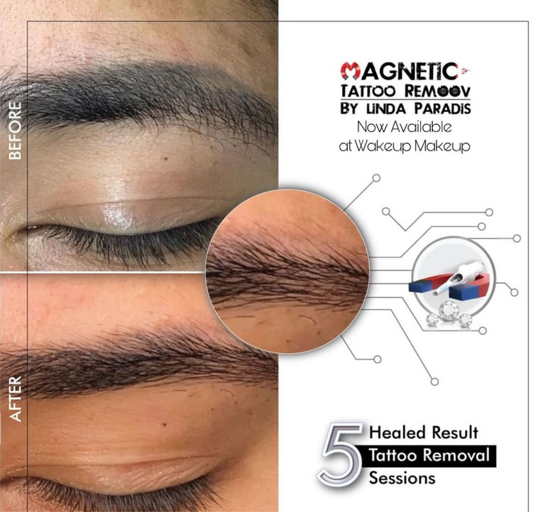Old Brow Removal