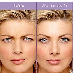 BOTOX® treatment targeting 11 lines between the eyebrows to reduce frown lines and create a smoother, relaxed appearance