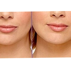 BOTOX® lip flip treatment offered by B TOX'D WITH BRITT to enhance the upper lip’s shape and create a fuller, natural-looking pout